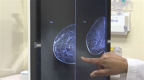 Health group recommends mammograms at 40, not 50